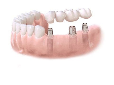 Locator Attachments For Dentures Auburn ME 4211